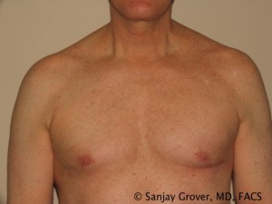 Gynecomastia Before and After | Sanjay Grover MD FACS