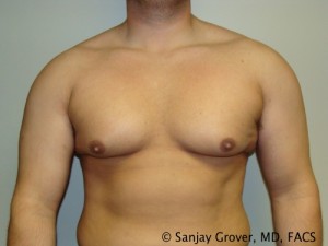 Gynecomastia Before and After | Grover Aesthetics