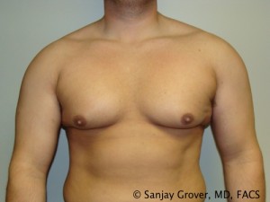 Gynecomastia Before and After 13 | Sanjay Grover MD FACS