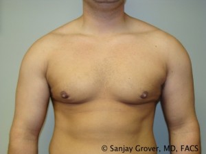 Gynecomastia Before and After | Grover Aesthetics