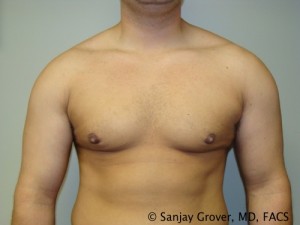 Gynecomastia Before and After 07 | Sanjay Grover MD FACS