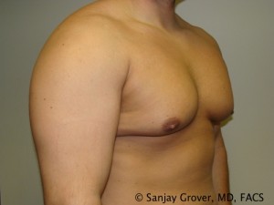 Gynecomastia Before and After 07 | Sanjay Grover MD FACS