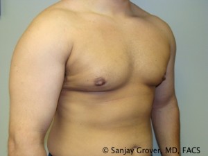 Gynecomastia Before and After 07 | Sanjay Grover MD FACS