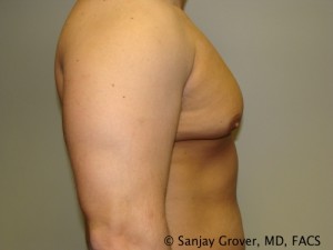 Gynecomastia Before and After 07 | Sanjay Grover MD FACS