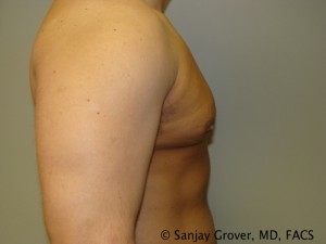 Gynecomastia Before and After 07 | Sanjay Grover MD FACS