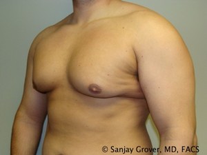 Gynecomastia Before and After 07 | Sanjay Grover MD FACS