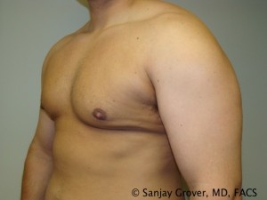 Gynecomastia Before and After 07 | Grover Aesthetics