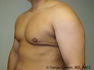 Gynecomastia Before and After 07 | Sanjay Grover MD FACS