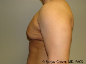 Gynecomastia Before and After 07 | Grover Aesthetics