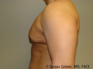 Gynecomastia Before and After 07 | Sanjay Grover MD FACS