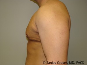 Gynecomastia Before and After 07 | Sanjay Grover MD FACS