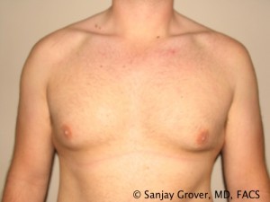Gynecomastia Before and After 14 | Sanjay Grover MD FACS