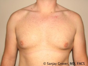 Gynecomastia Before and After | Grover Aesthetics