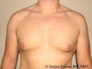 Gynecomastia Before and After 18 | Sanjay Grover MD FACS