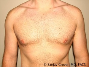 Gynecomastia Before and After | Grover Aesthetics