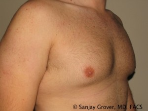 Gynecomastia Before and After 08 | Sanjay Grover MD FACS