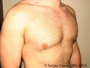 Gynecomastia Before and After 08 | Sanjay Grover MD FACS