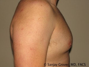 Gynecomastia Before and After 08 | Sanjay Grover MD FACS