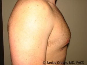 Gynecomastia Before and After 08 | Sanjay Grover MD FACS