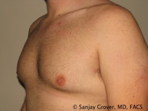 Gynecomastia Before and After 08 | Sanjay Grover MD FACS