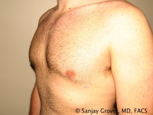 Gynecomastia Before and After 08 | Sanjay Grover MD FACS