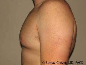 Gynecomastia Before and After 08 | Sanjay Grover MD FACS