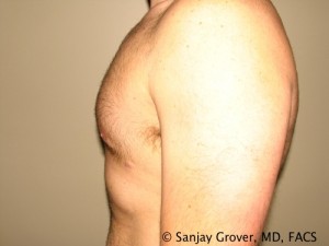 Gynecomastia Before and After 08 | Grover Aesthetics
