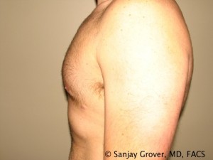 Gynecomastia Before and After 08 | Sanjay Grover MD FACS