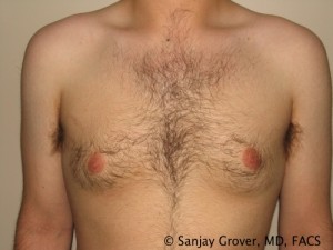 Gynecomastia Before and After | Grover Aesthetics