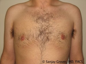 Gynecomastia Before and After | Grover Aesthetics