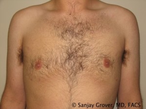 Gynecomastia Before and After | Sanjay Grover MD FACS