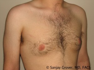 Gynecomastia Before and After 09 | Grover Aesthetics