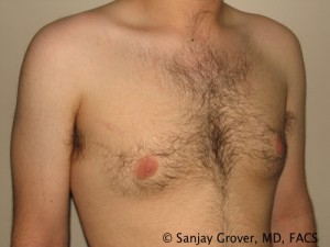 Gynecomastia Before and After 09 | Sanjay Grover MD FACS