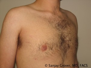 Gynecomastia Before and After 09 | Sanjay Grover MD FACS