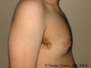 Gynecomastia Before and After 09 | Grover Aesthetics