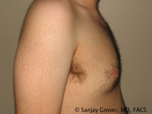 Gynecomastia Before and After 09 | Sanjay Grover MD FACS