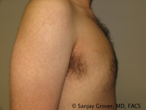Gynecomastia Before and After 09 | Grover Aesthetics