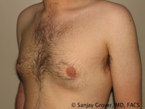 Gynecomastia Before and After 09 | Sanjay Grover MD FACS