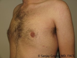 Gynecomastia Before and After 09 | Sanjay Grover MD FACS