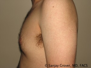 Gynecomastia Before and After 09 | Sanjay Grover MD FACS