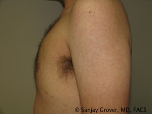 Gynecomastia Before and After 09 | Sanjay Grover MD FACS