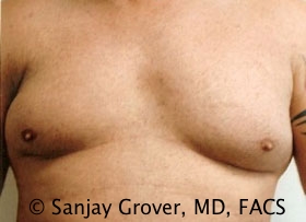 Gynecomastia Before and After 16 | Sanjay Grover MD FACS