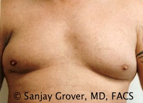 Gynecomastia Before and After | Grover Aesthetics