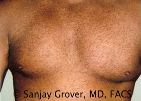 Gynecomastia Before and After | Grover Aesthetics