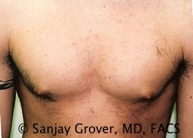 Gynecomastia Before and After | Grover Aesthetics