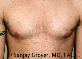 Gynecomastia Before and After | Grover Aesthetics