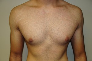 Gynecomastia Before and After | Grover Aesthetics