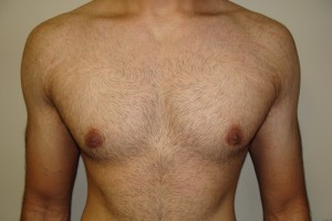 Gynecomastia Before and After | Grover Aesthetics