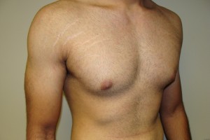 Gynecomastia Before and After 12 | Grover Aesthetics