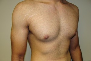 Gynecomastia Before and After 12 | Sanjay Grover MD FACS